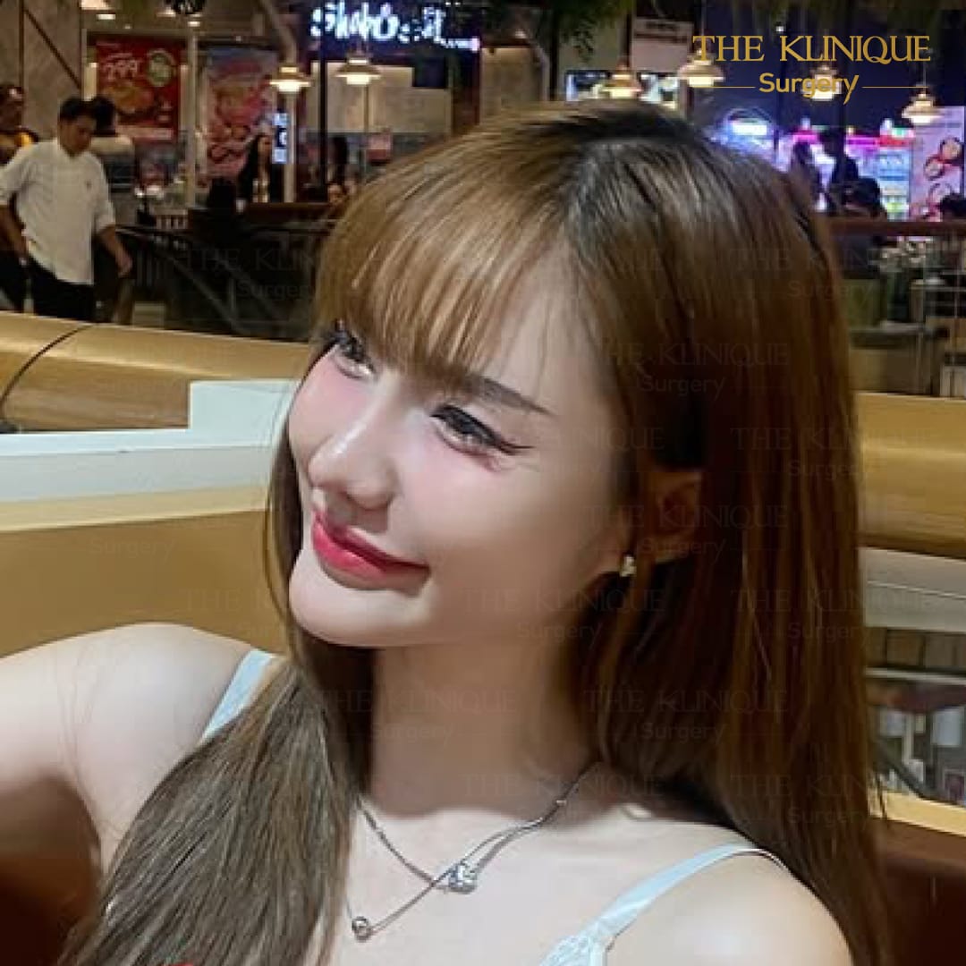 After เสริมจมูก semi