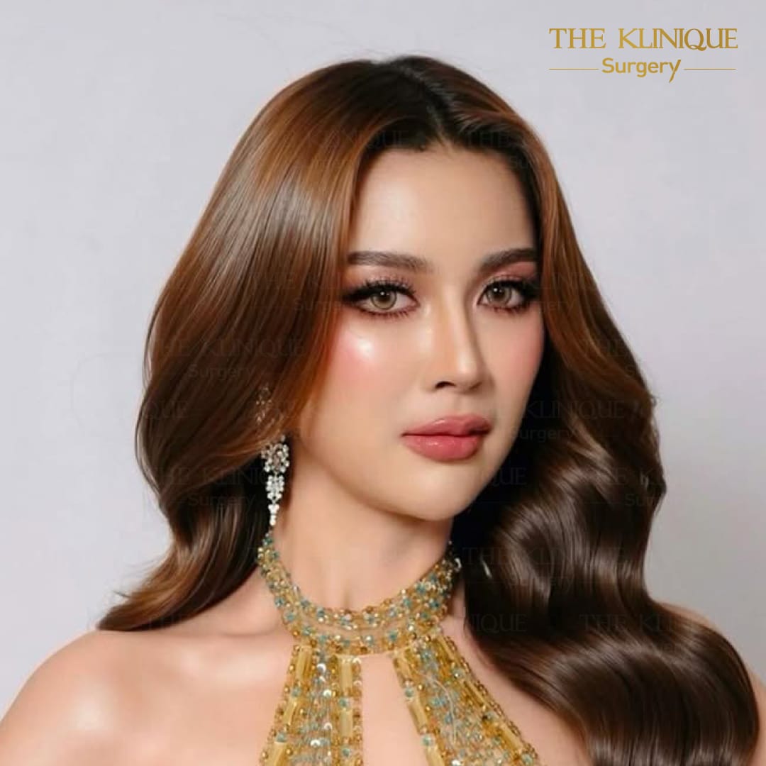 รีวิวเสริมจมูก semi open