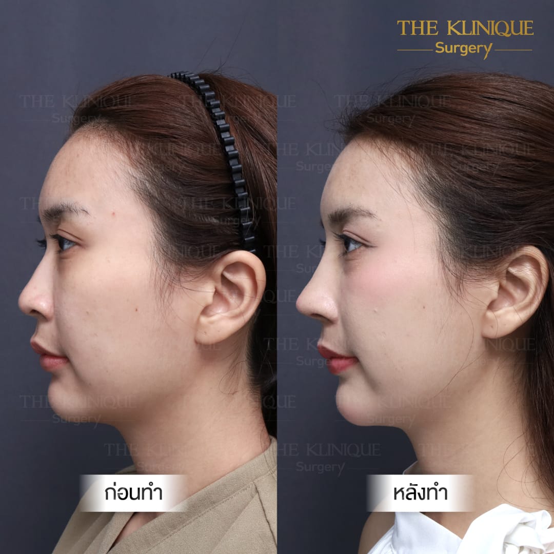 B/A เสริมจมูก semi