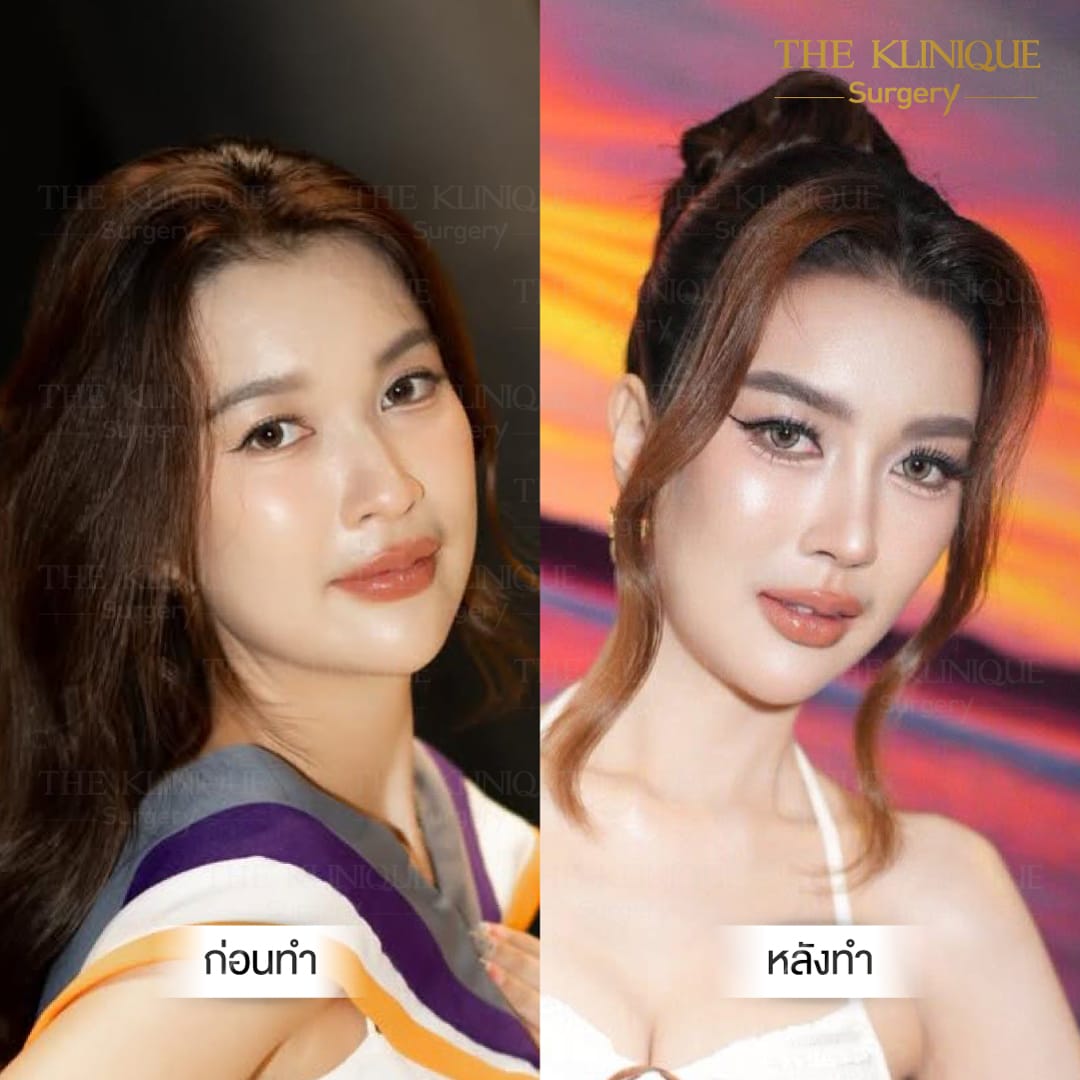 B/A เสริมจมูก semi