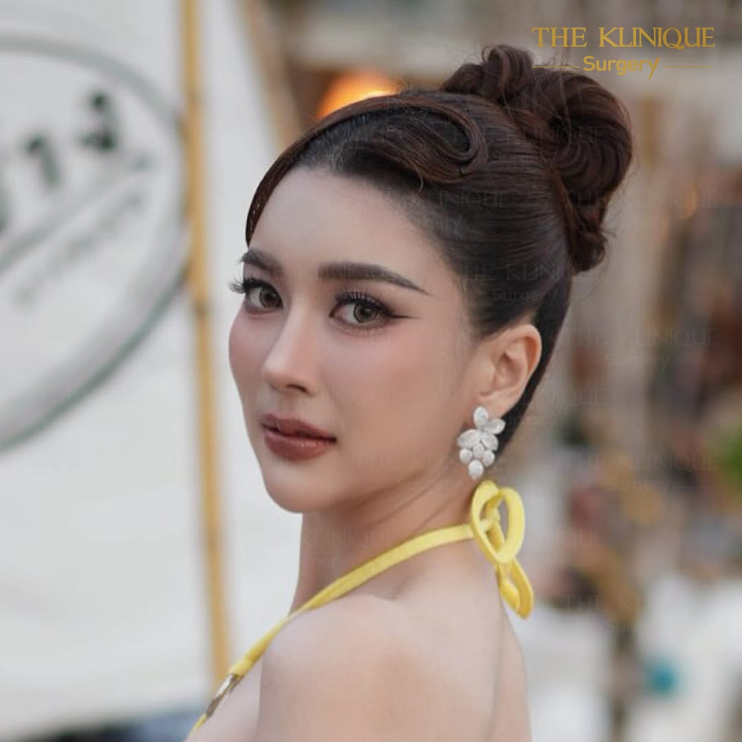 รีวิวเสริมจมูก semi open