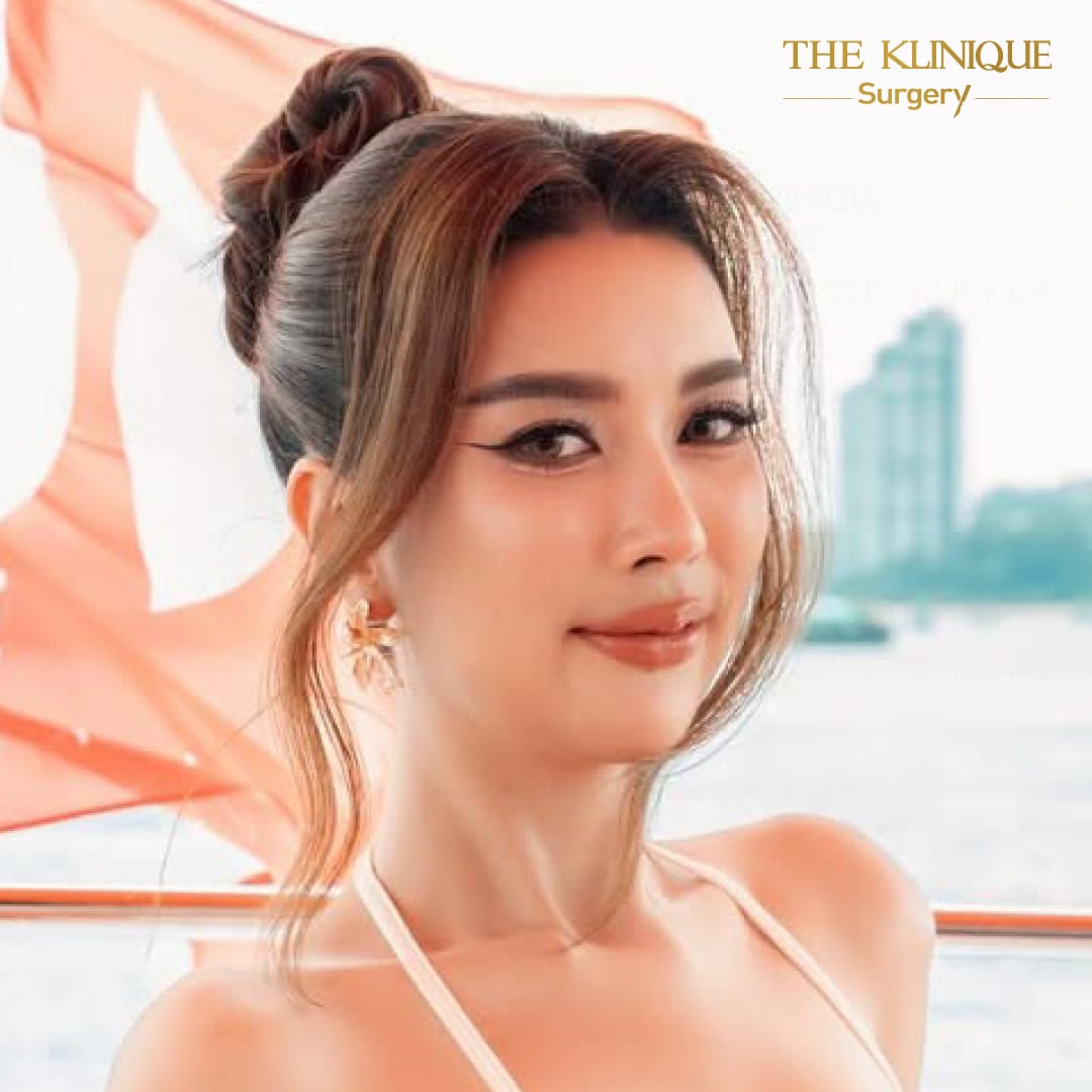 รีวิวเสริมจมูก semi open