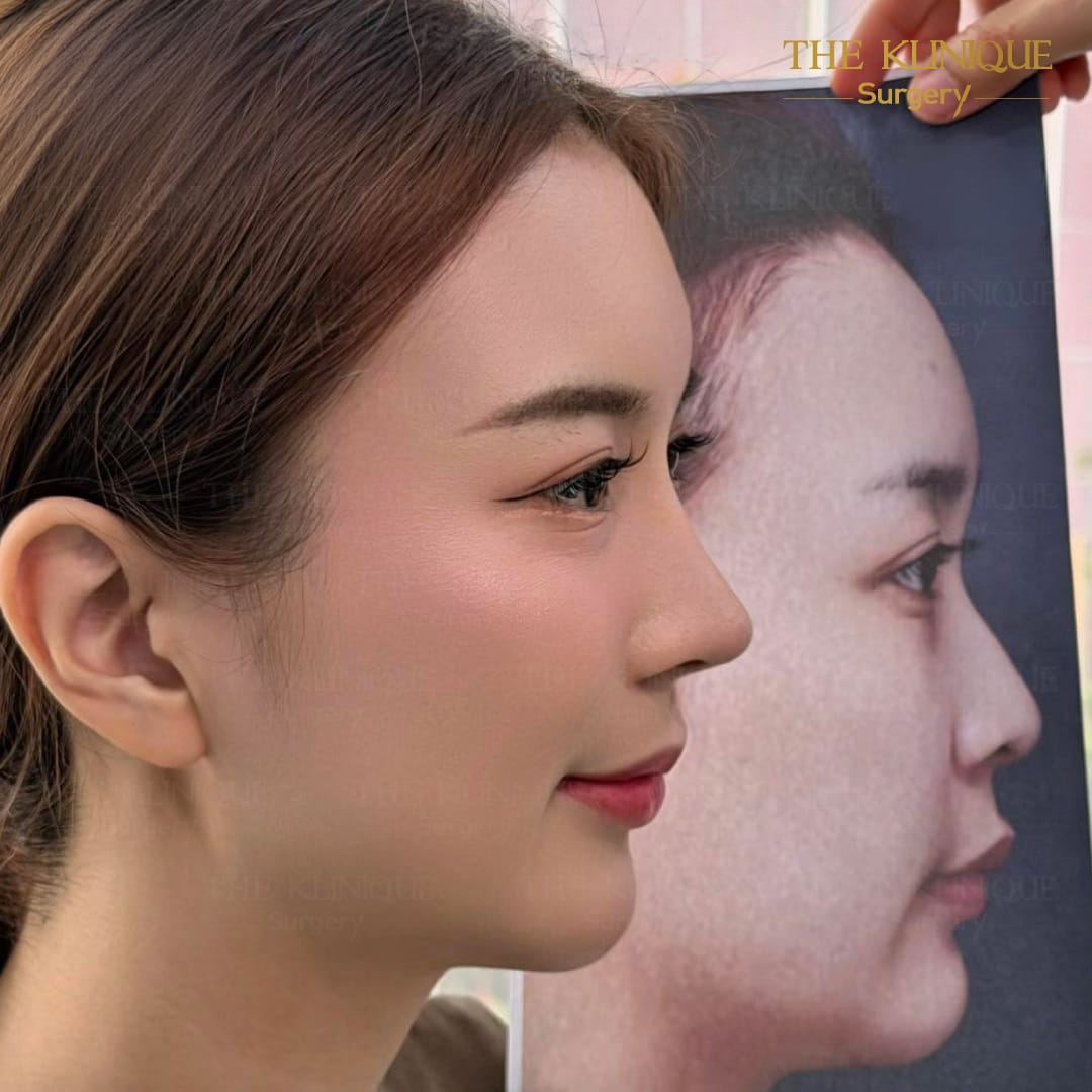 Before After หลังเสริมจมูก