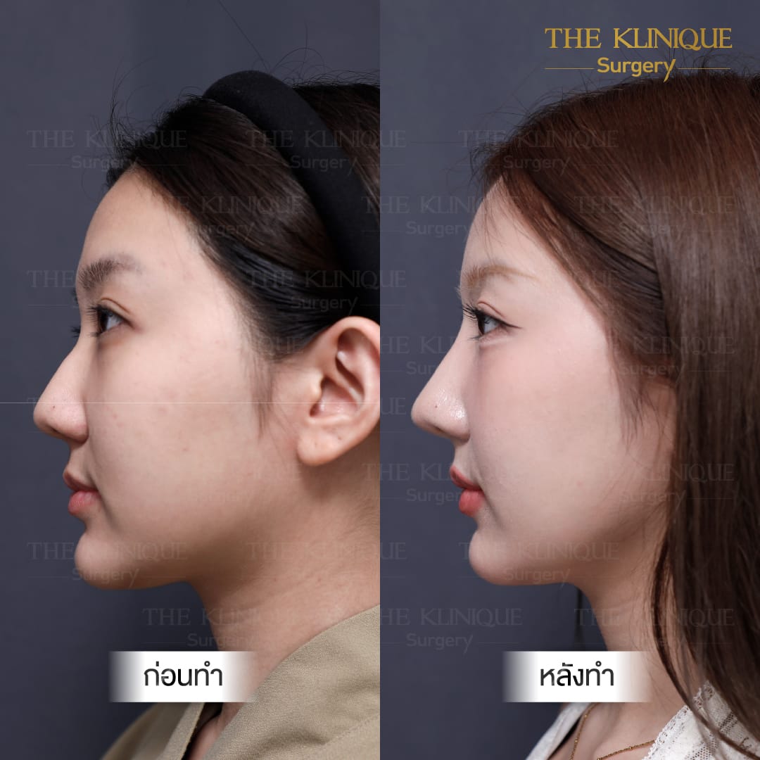 Before After เสริมจมูก Semi Open