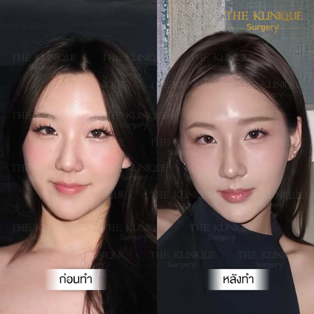 Before After เสริมจมูก Semi Open