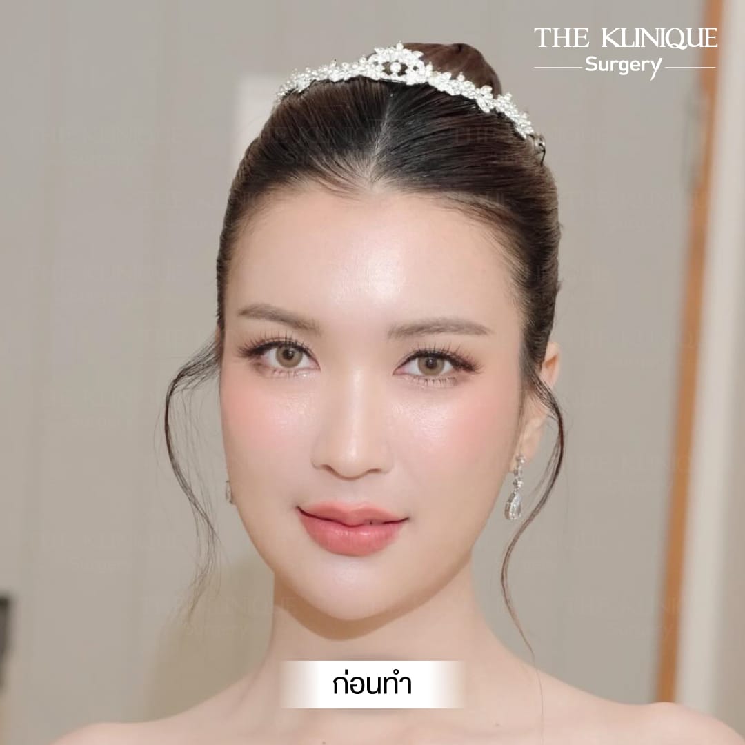 หลังเสริมจมูก Semi Open