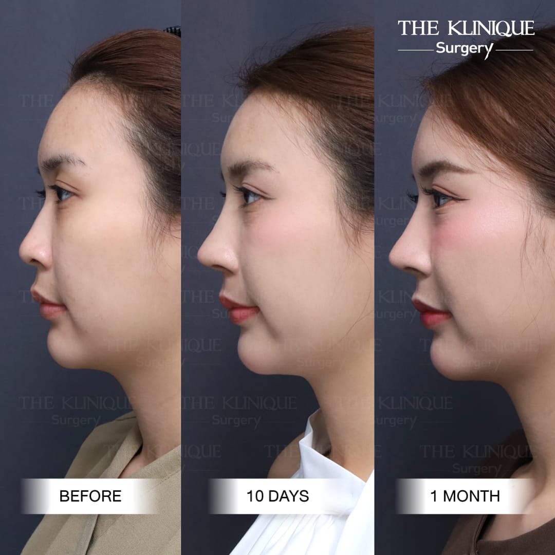 รีวิวเสริมจมูก Semi Open