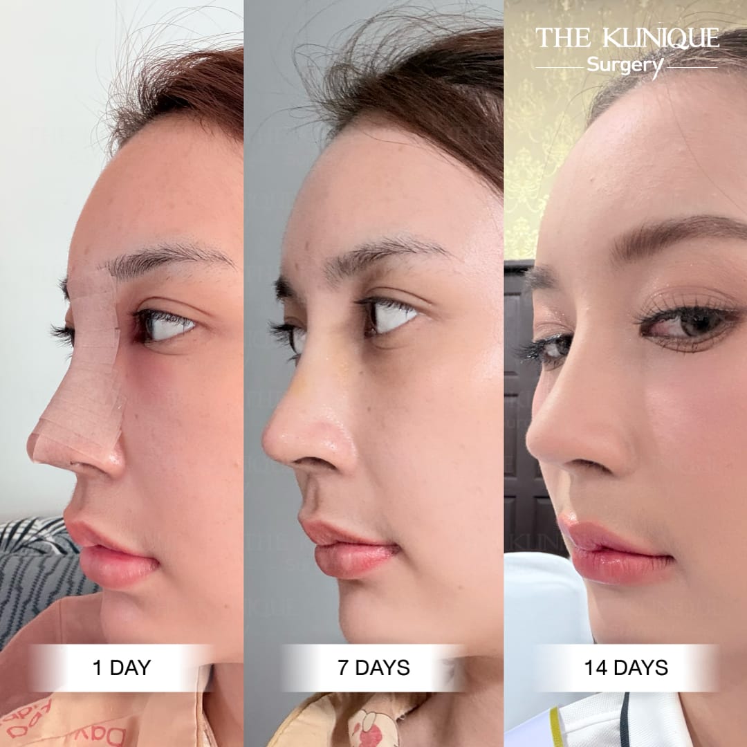 รีวิวเสริมจมูก Semi Open
