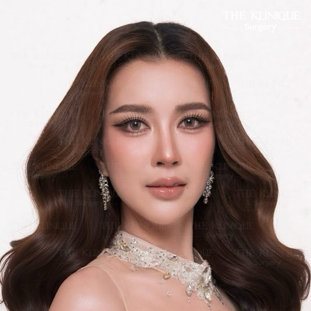 รีวิวเสริมจมูก Semi Open แพรพลอย MUT ชลบุรี