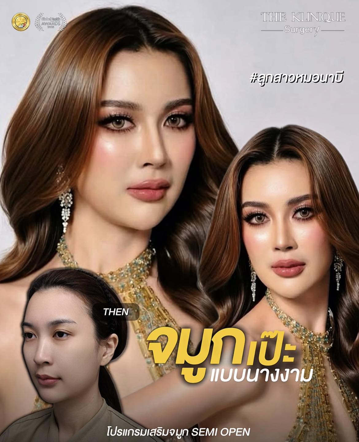 รีวิวเสริมจมูก Semi Open แพรพลอย MUT ชลบุรี