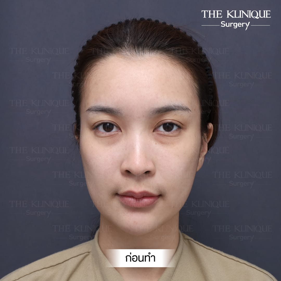 รีวิวแก้จมูก Semi Open