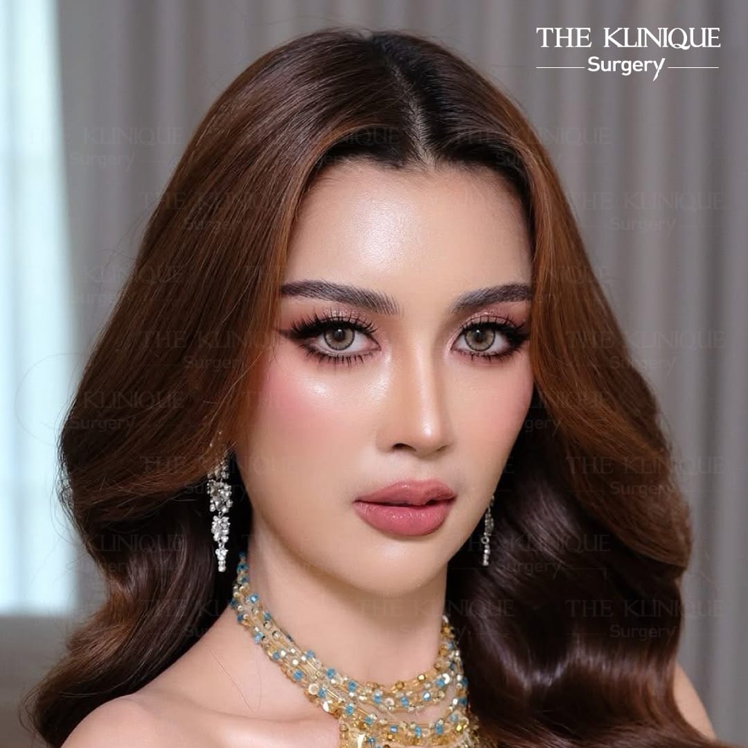 รีวิวเสริมจมูก Semi Open แพรพลอย MUT ชลบุรี