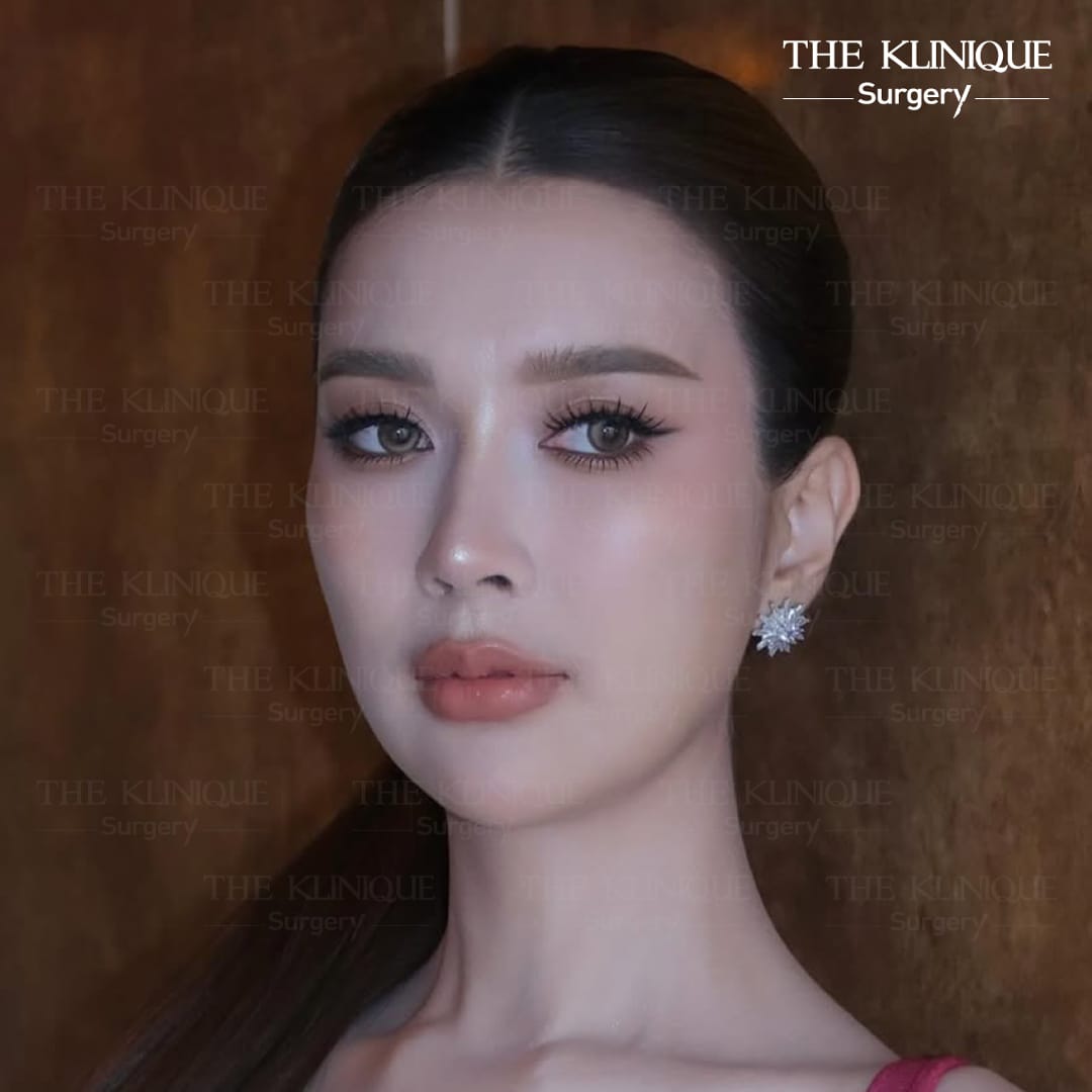 หลังเสริมจมูก Semi Open