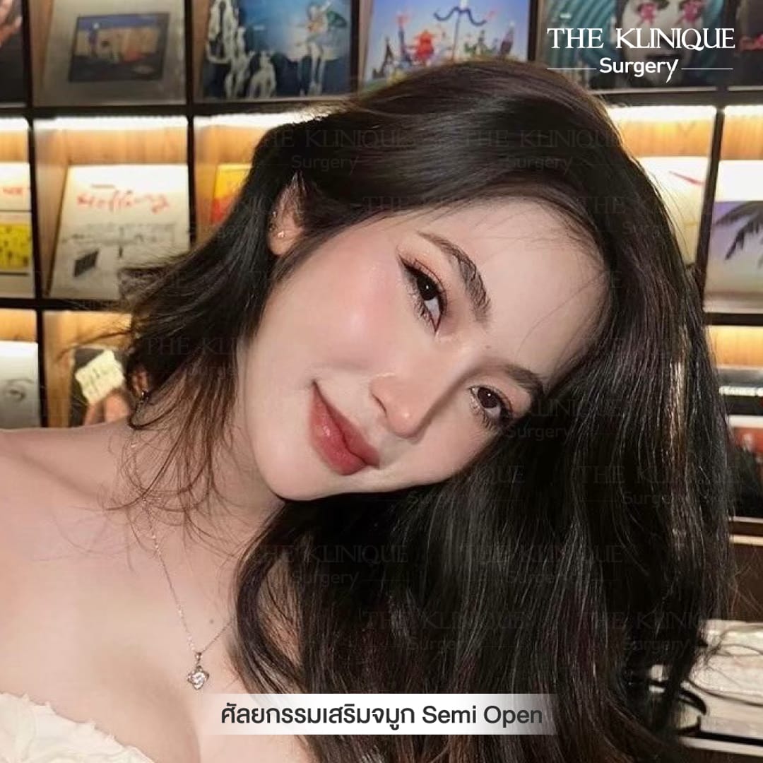 After เสริมจมูก semi