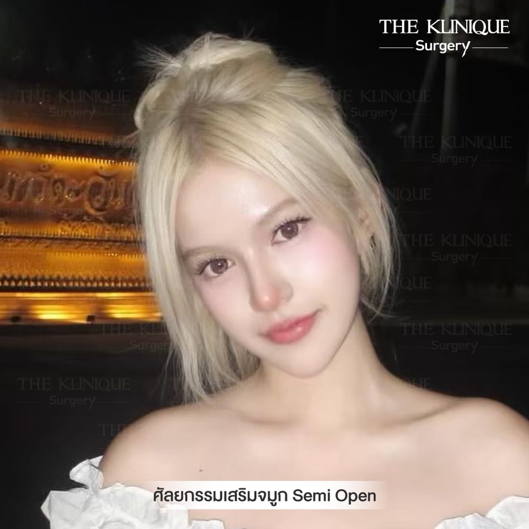 After เสริมจมูก semi
