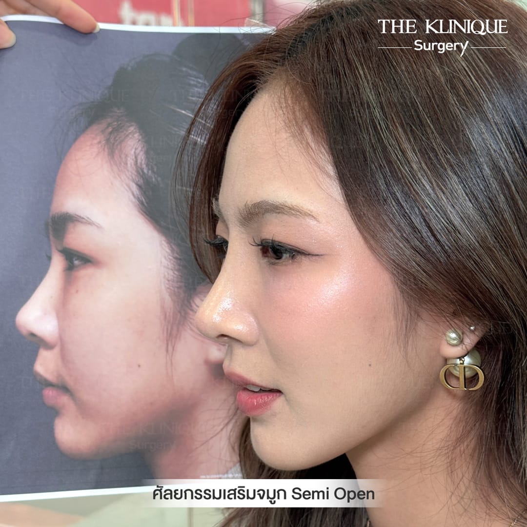 B/A เสริมจมูก semi