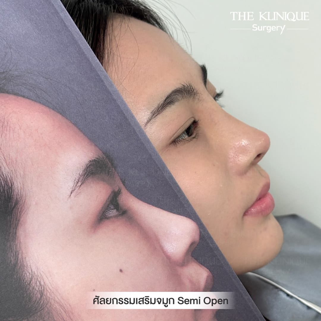B/A เสริมจมูก semi