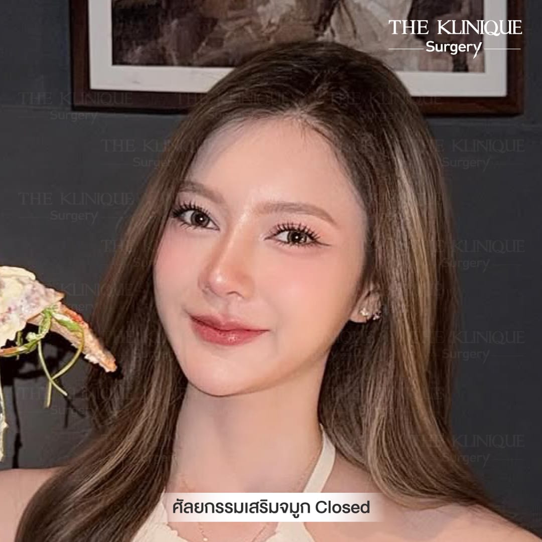 รีวิว เสริมจมูก Semi Opem