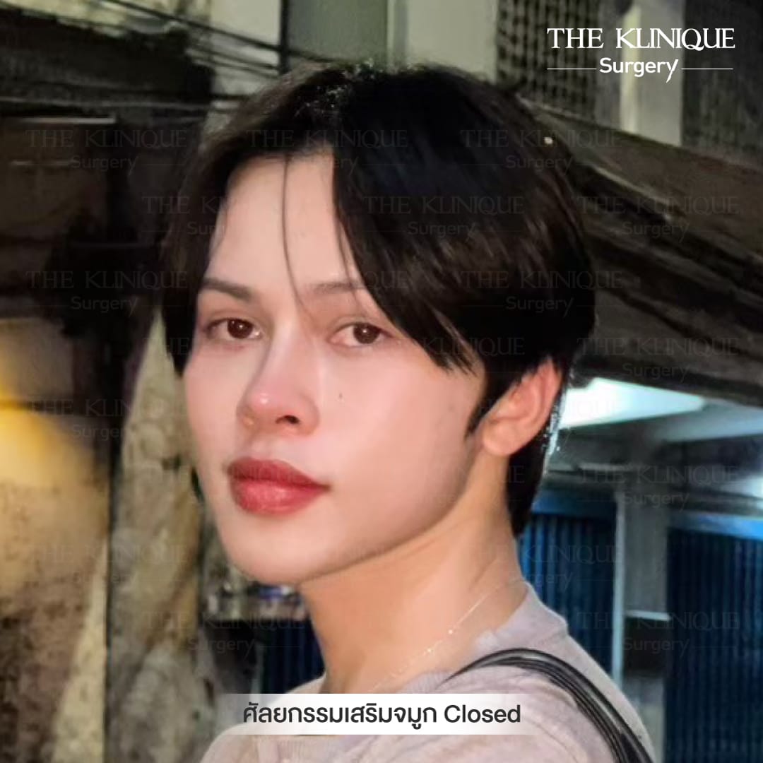 รีวิว เสริมจมูก Semi Opem