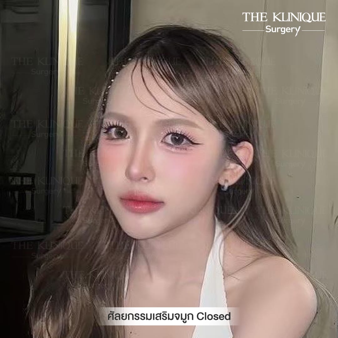 รีวิว เสริมจมูก Semi Opem