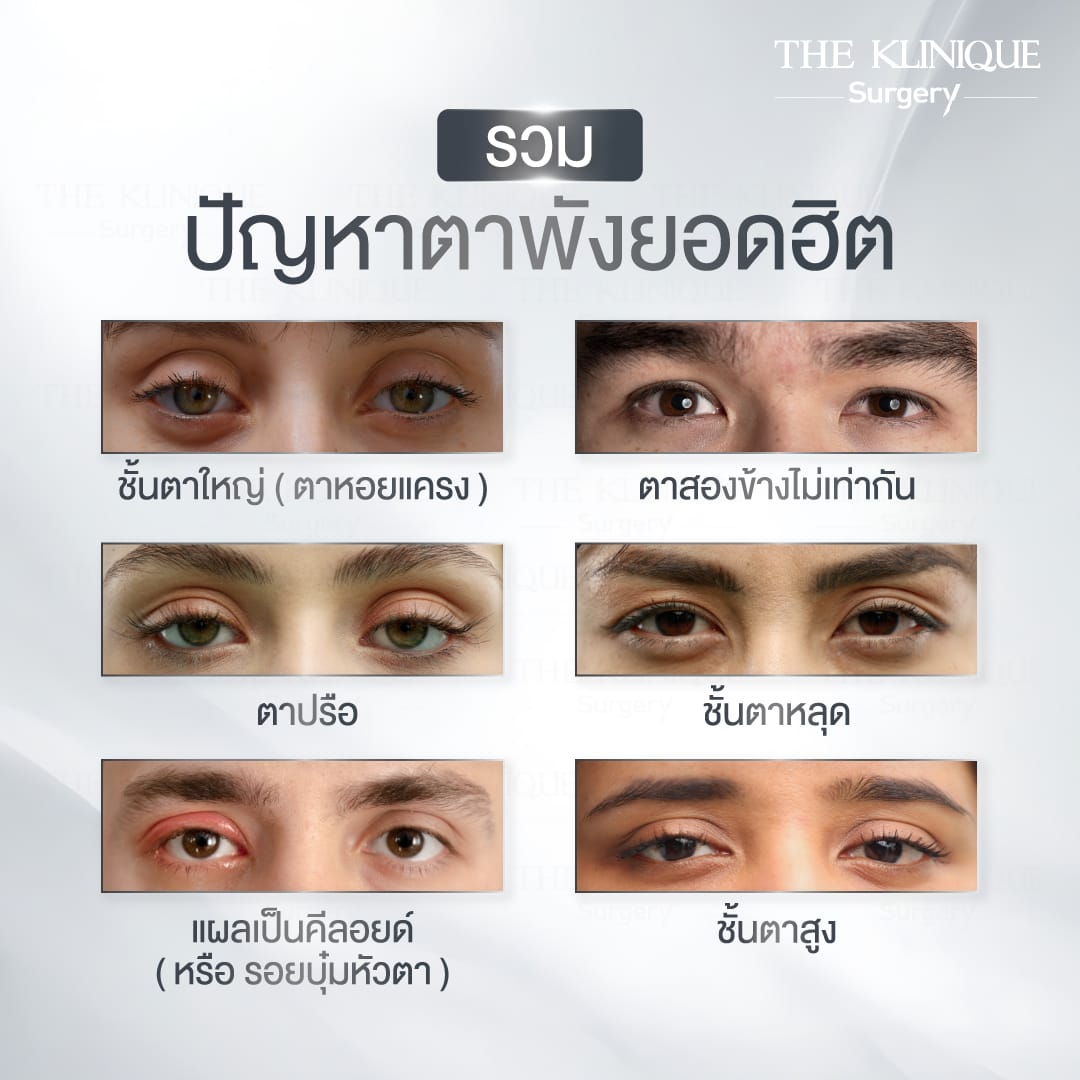 แก้ตาสองชั้น
