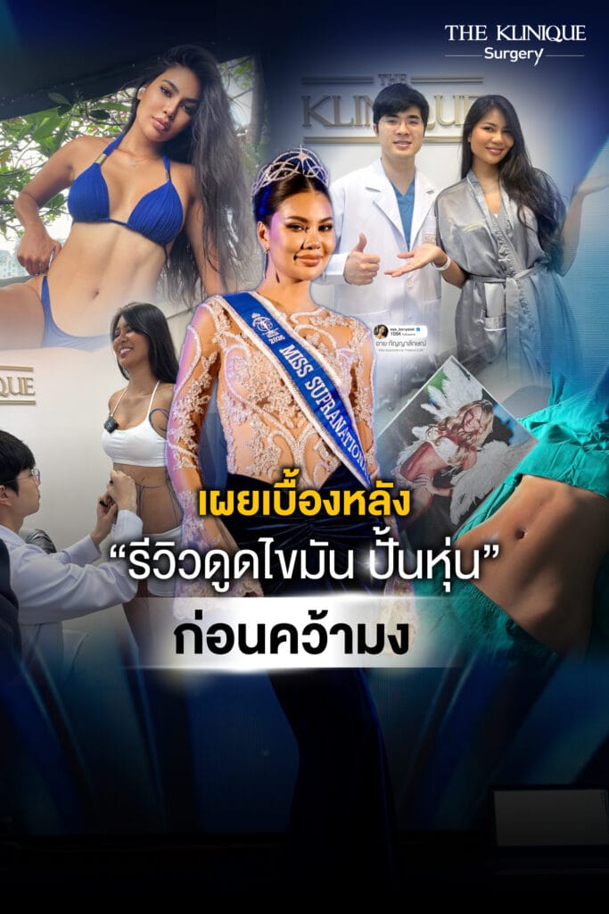 รีวิวดูดไขมันหน้าท้อง อาย