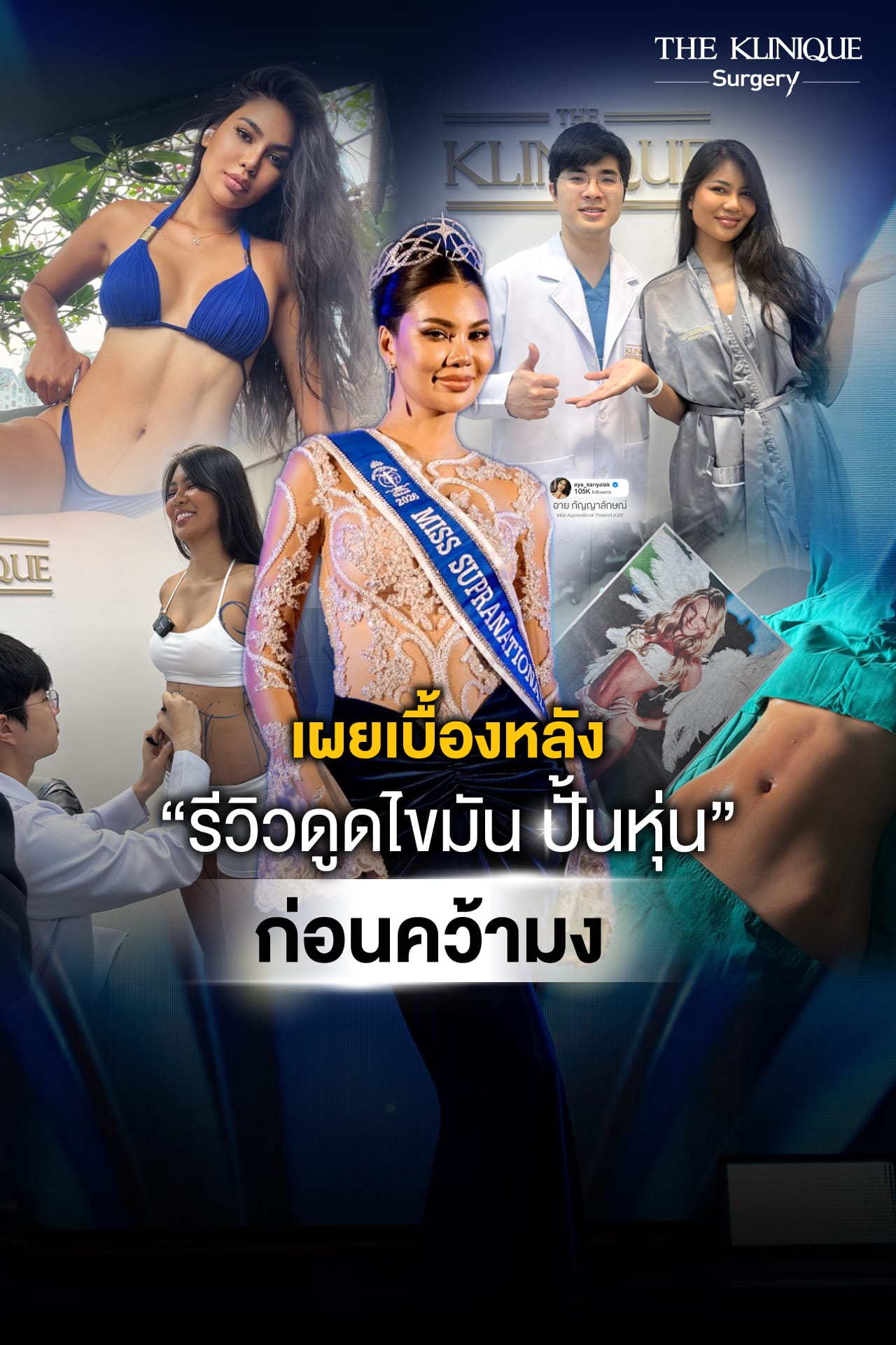 รีวิวดูดไขมันหน้าท้อง อาย