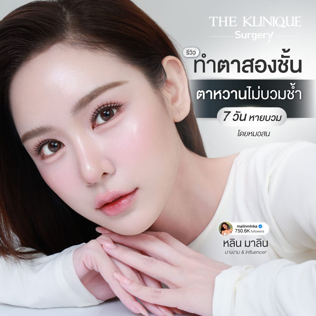 รีวิวทำตาสองชั้น Double Eyelid Surgery โดยหมอสน จักษุแพทย์