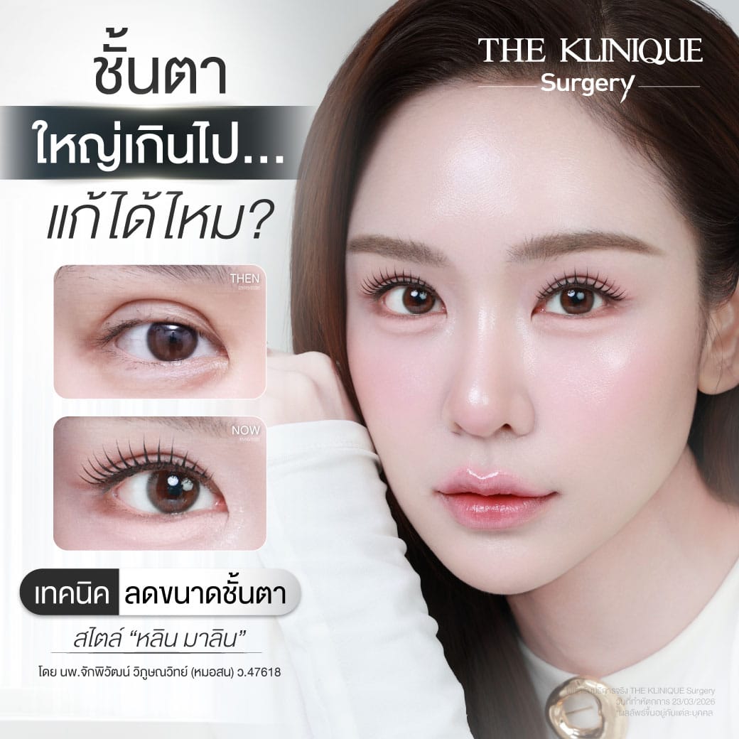 รีวิวแก้ตาสองชั้น ลดขนาดชั้นตาที่ใหญ่