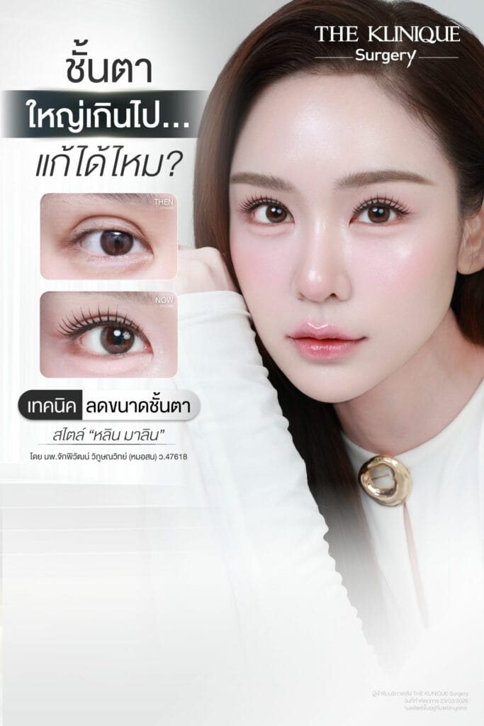 รีวิวแก้ตาสองชั้น ลดขนาดชั้นตาที่ใหญ่