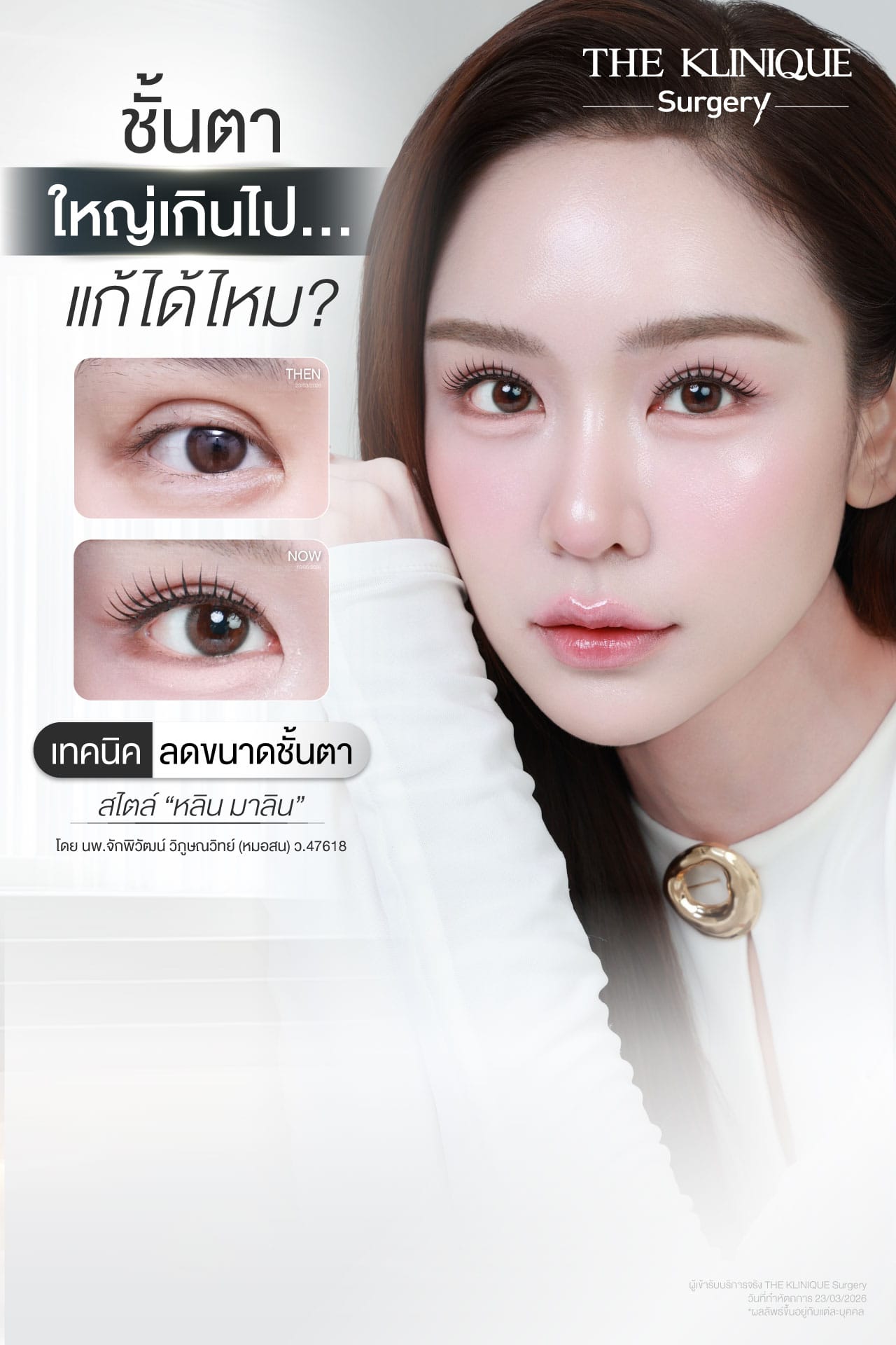 รีวิวแก้ตาสองชั้น ลดขนาดชั้นตาที่ใหญ่