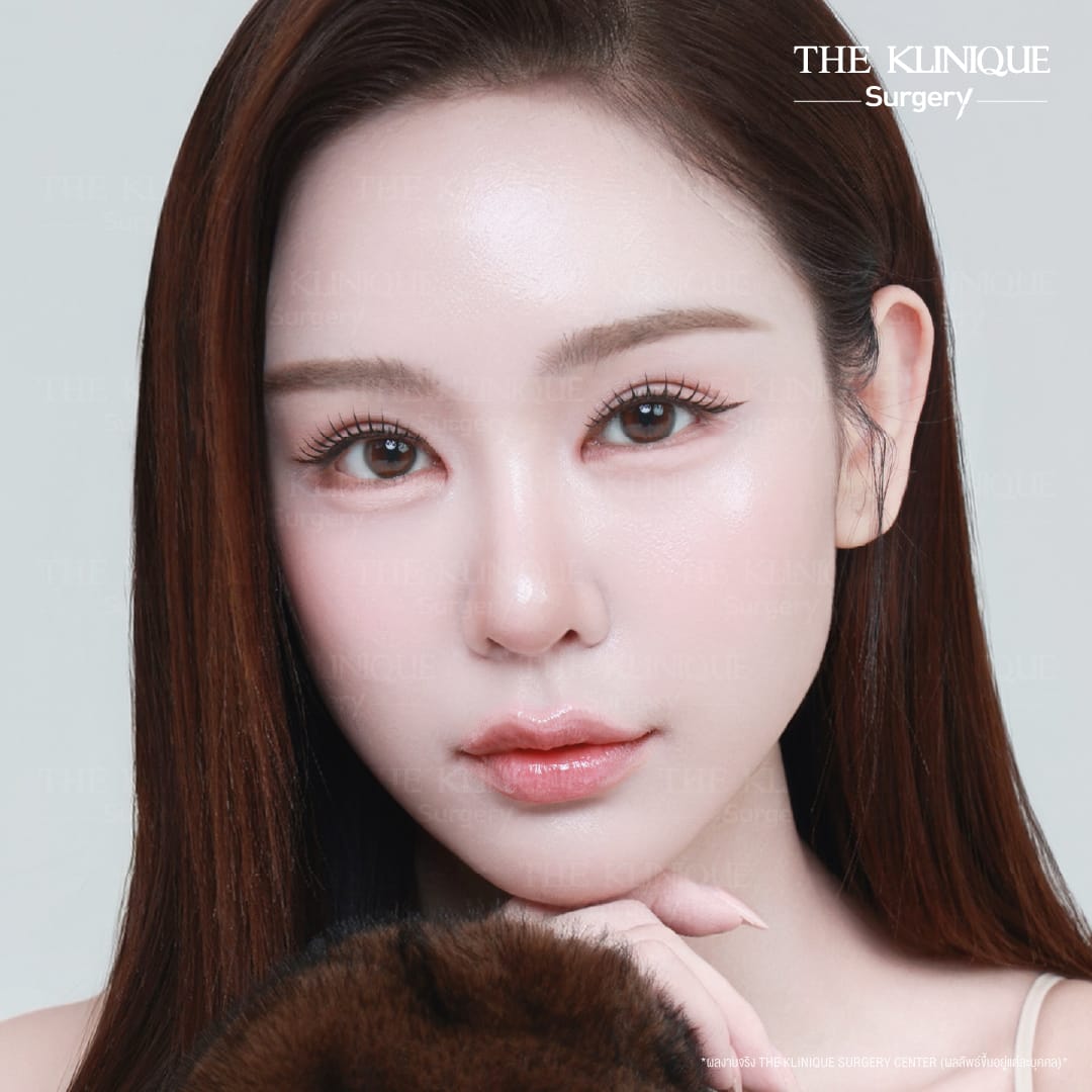 รีวิวทำตาสองชั้น 7 วัน