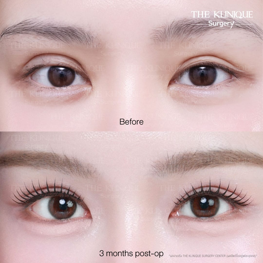 Before After ทำตาสองชั้น