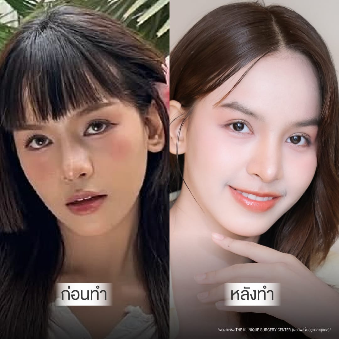 Before After ทำตาสองชั้น