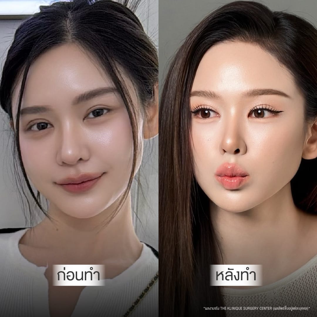 Before After ทำตาสองชั้น