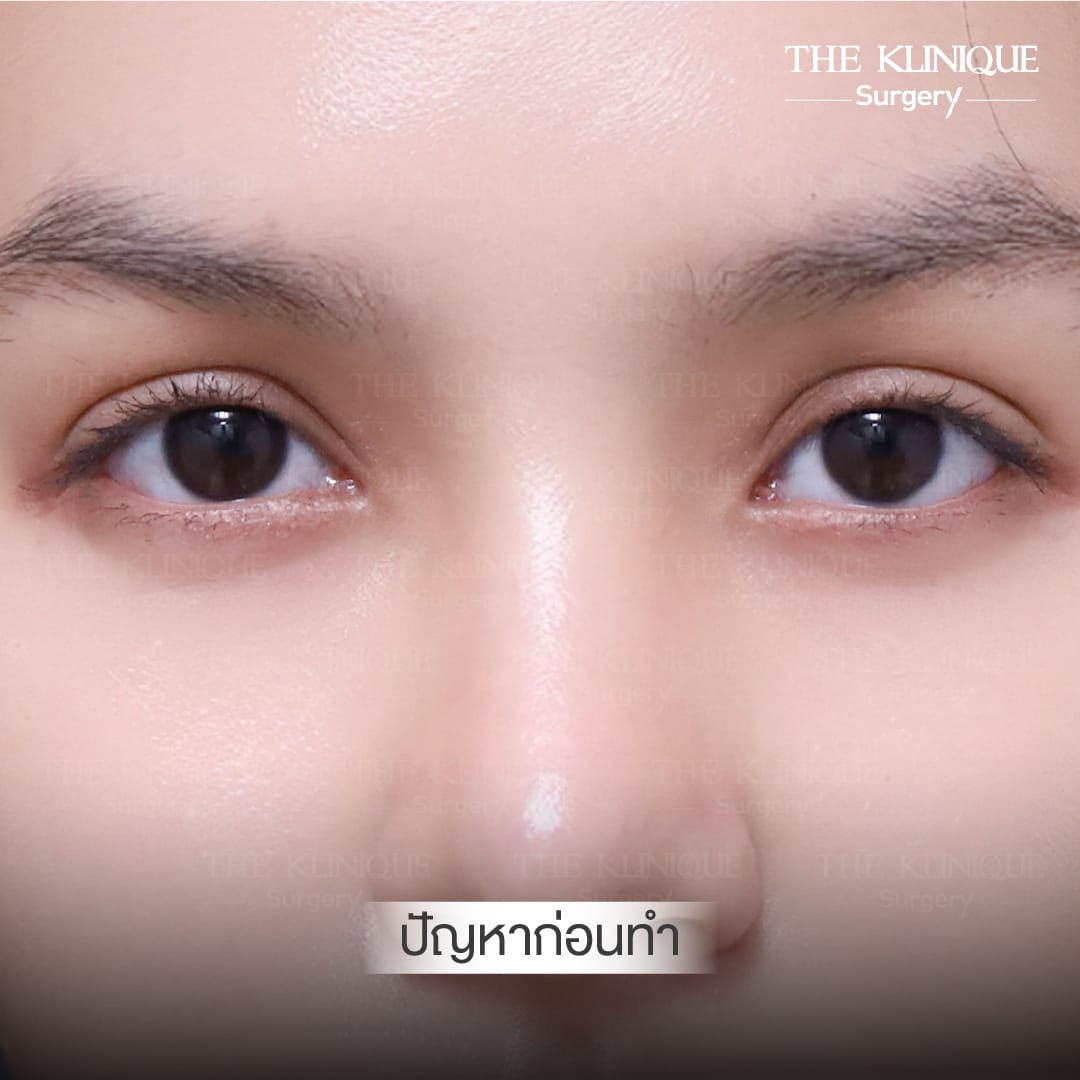 Before After ทำตาสองชั้น