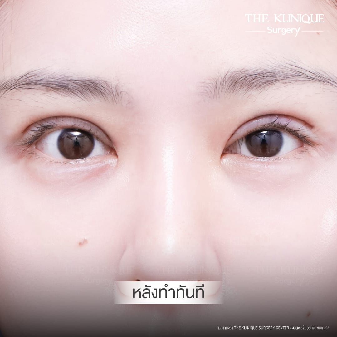 Before After ทำตาสองชั้น