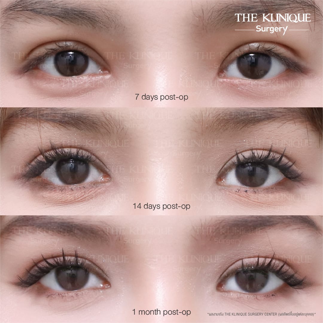 Before After ทำตาสองชั้น