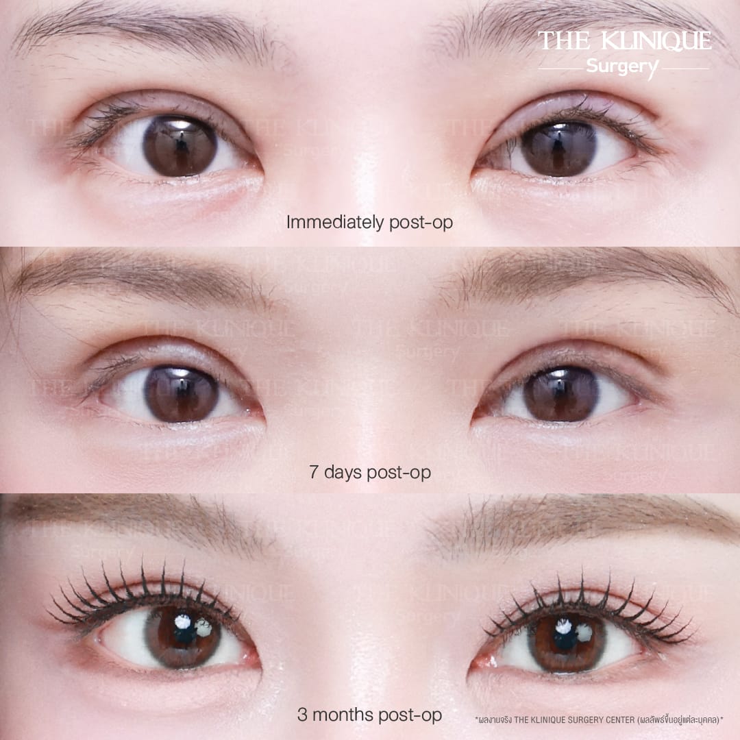 Before After ทำตาสองชั้น