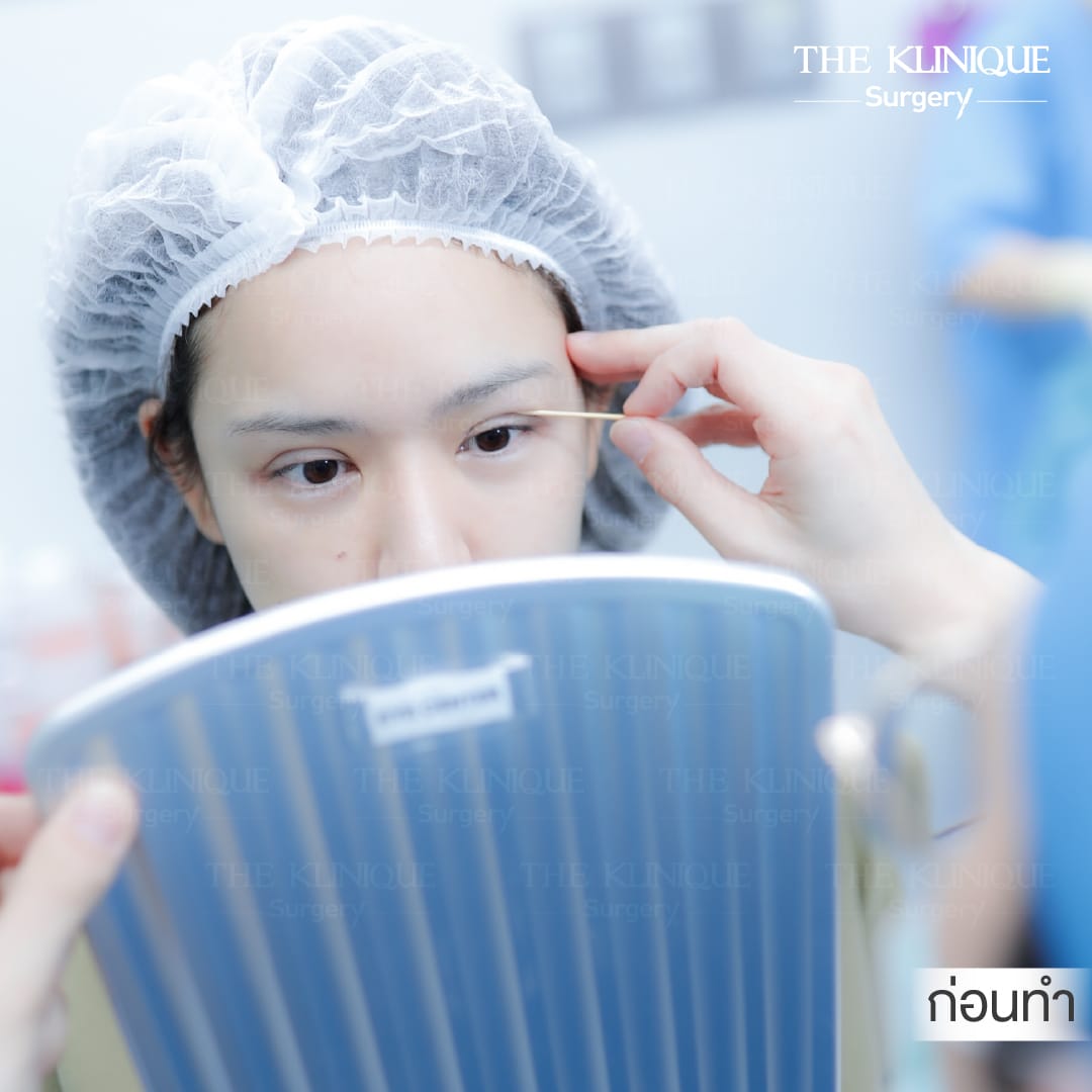 รีวิวทำตาสองชั้น 7 วัน