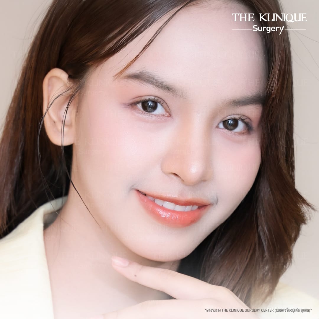 รีวิวทำตาสองชั้น 7 วัน