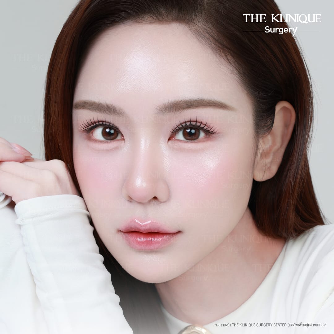 รีวิวทำตาสองชั้น Double Eyelid Surgery โดยหมอสน จักษุแพทย์