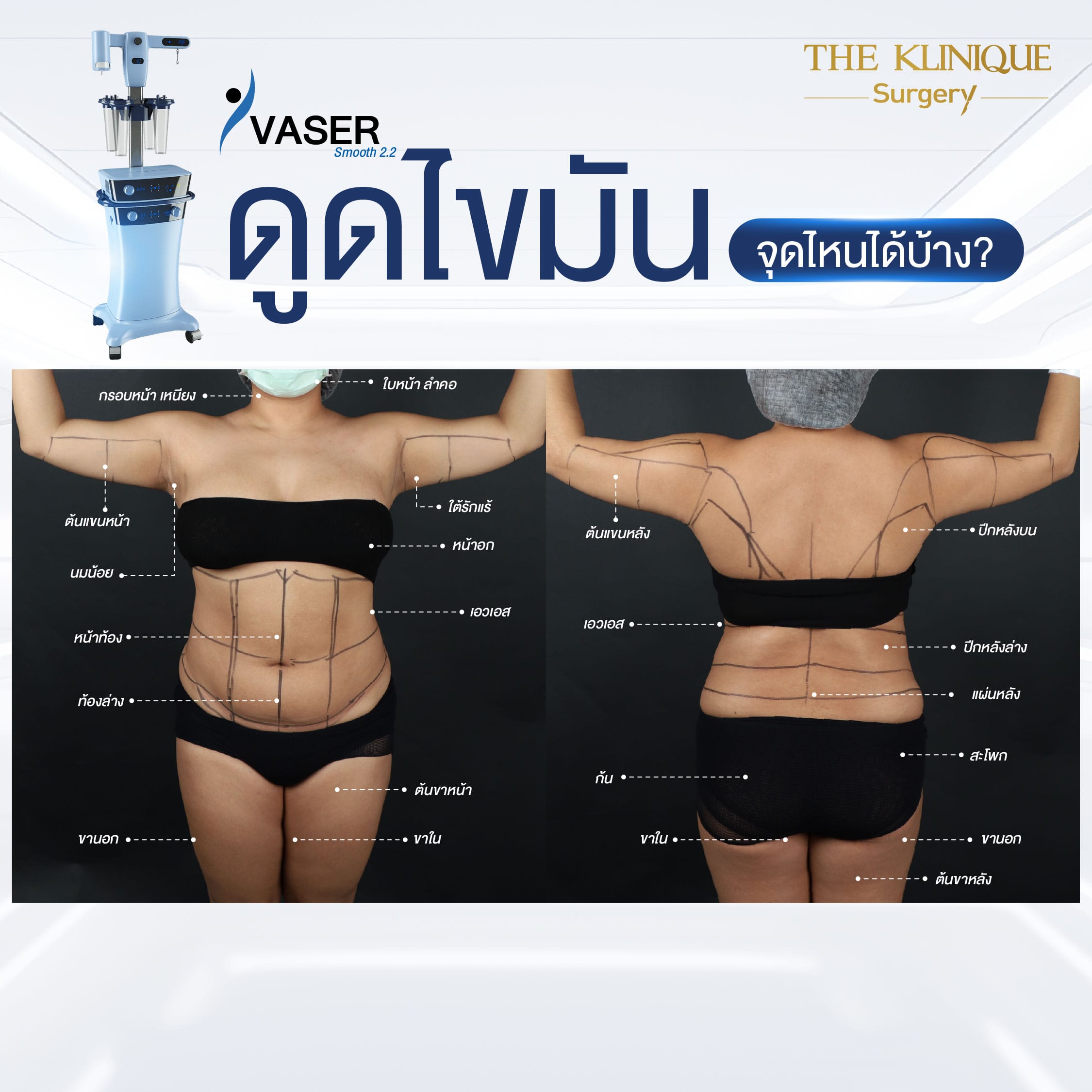 ดูดไขมันจุดไหนได้บ้าง