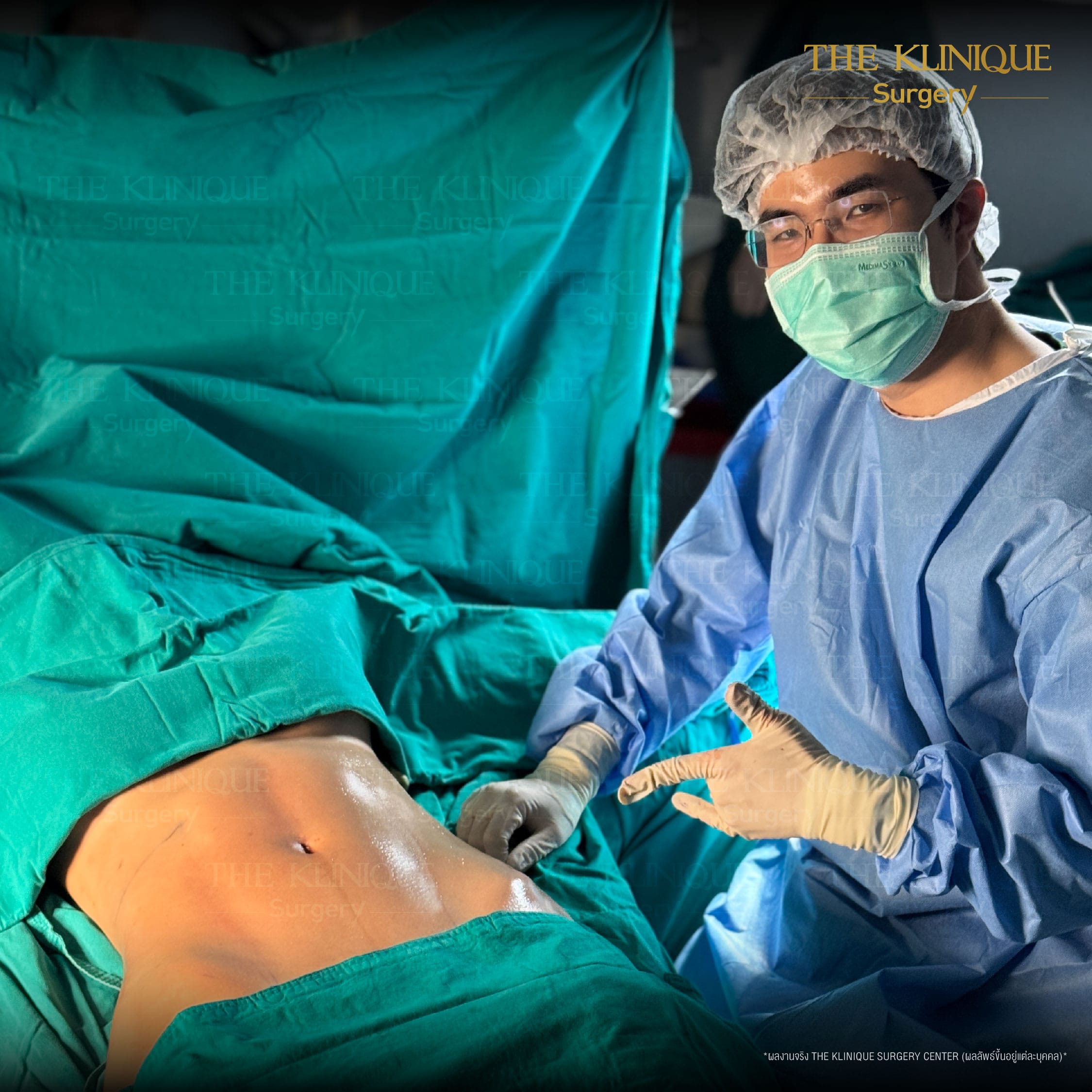 After Lipo