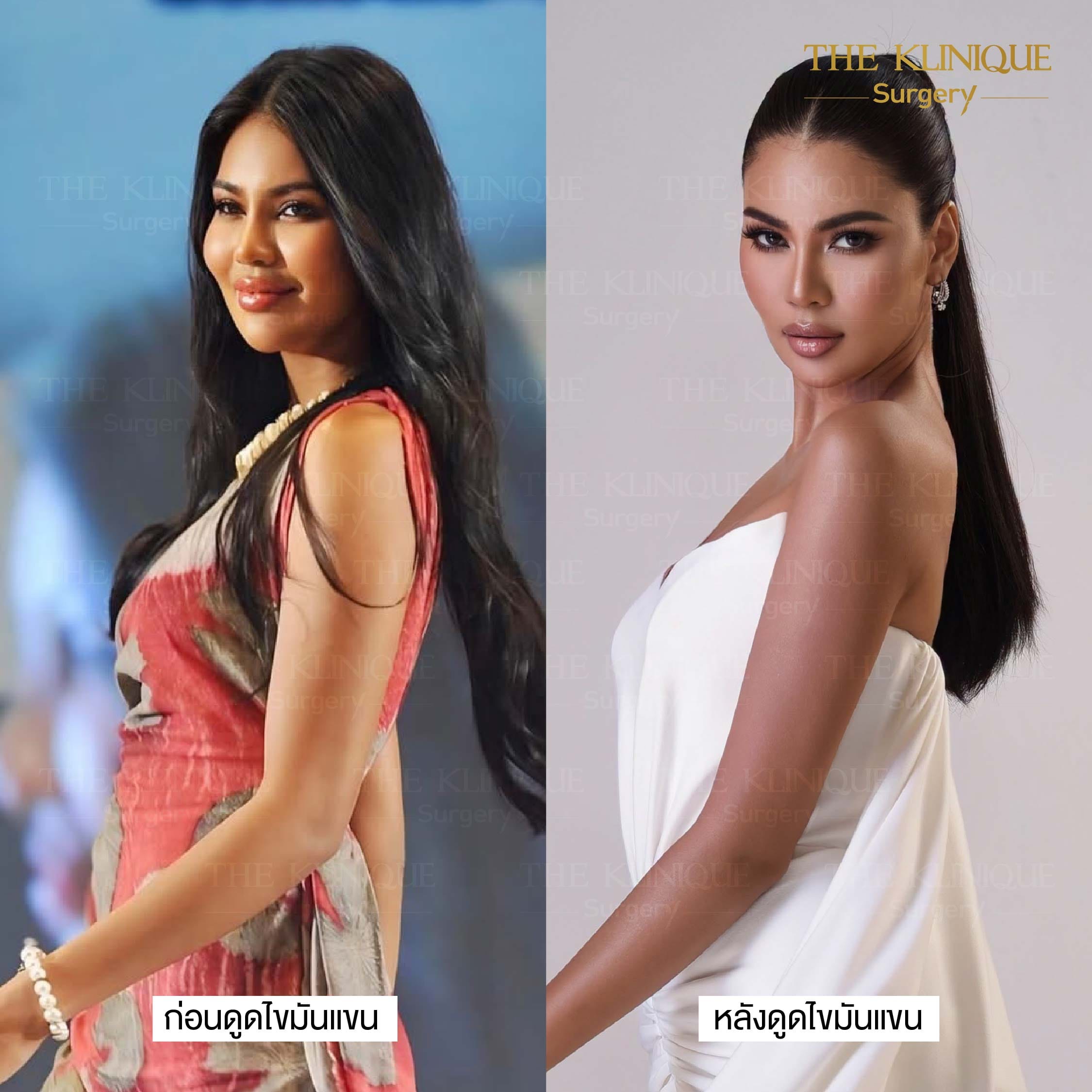 B/A ดูดไขมันหน้าท้อง อาย