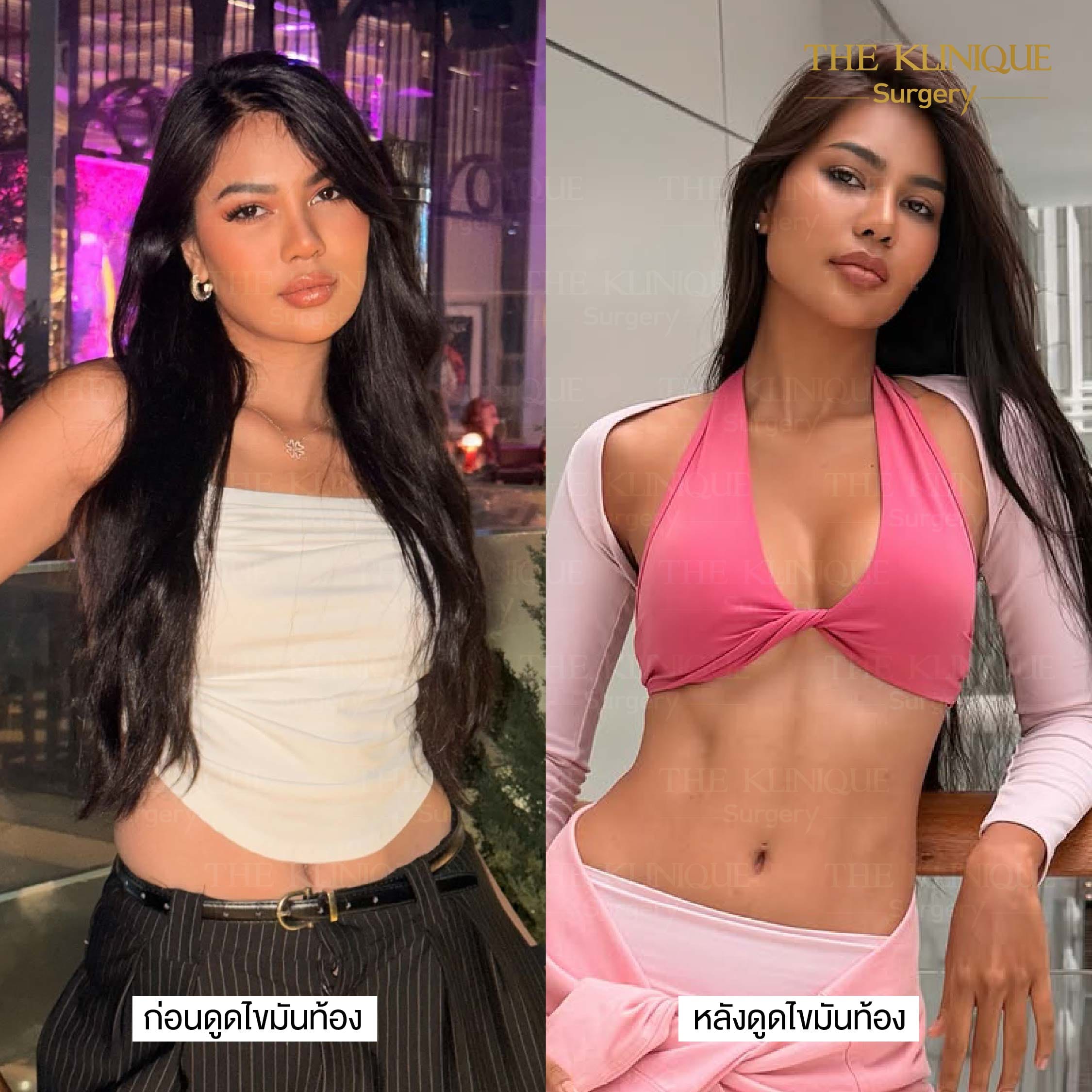 B/A ดูดไขมันหน้าท้อง อาย