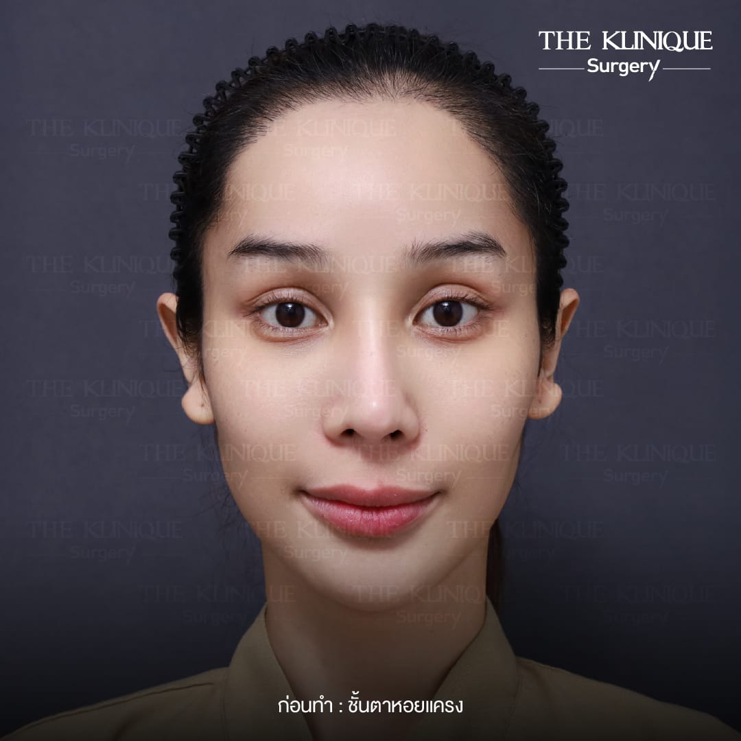 รีวิวแก้ตาสองชั้น ลดขนาดชั้นตาที่ใหญ่