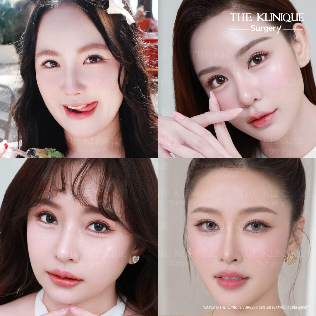 รีวิวแก้ตาสองชั้น ลดขนาดชั้นตาที่ใหญ่