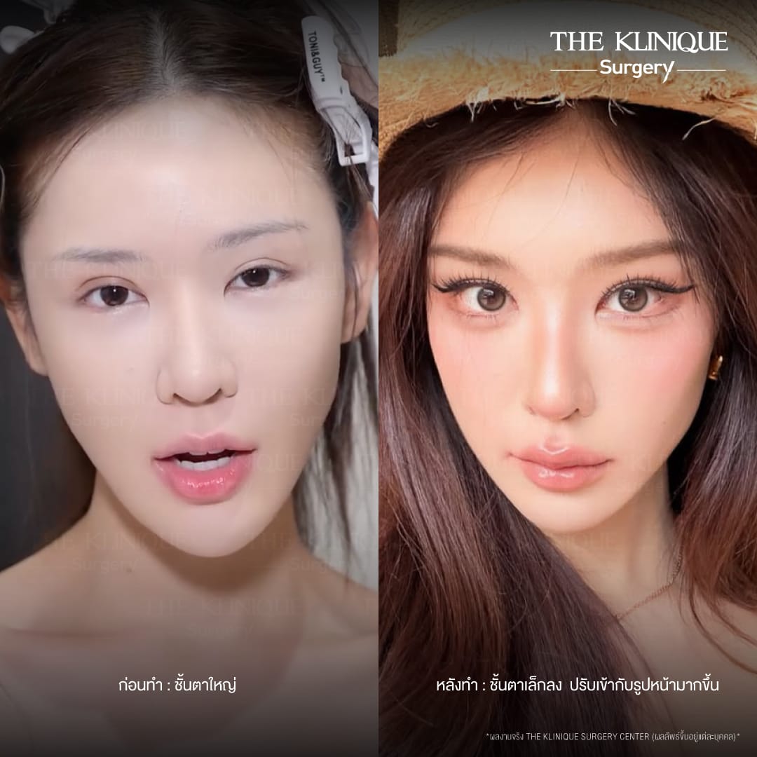 รีวิวแก้ตาสองชั้น ลดขนาดชั้นตาที่ใหญ่