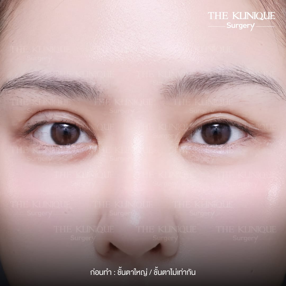 รีวิวแก้ตาสองชั้น ลดขนาดชั้นตาที่ใหญ่